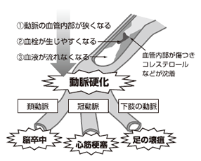 動脈硬化