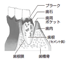 歯周病
